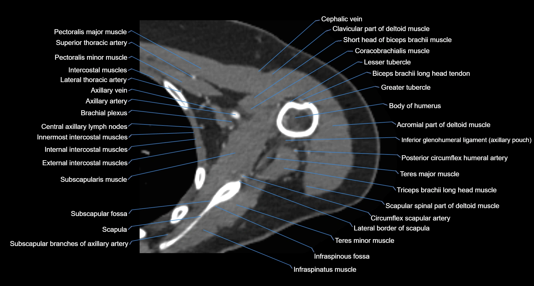CT Shoulder axial cross sectional anatomy labelled radiology image -00046.webp